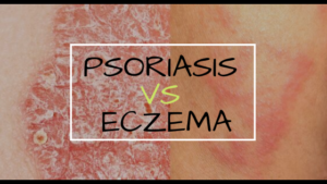 Psoriasis vs Eczema