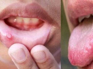 how to cure mouth ulcers fast naturally