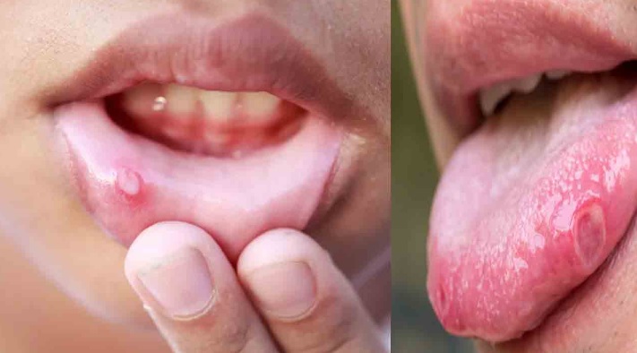 how to cure mouth ulcers fast naturally